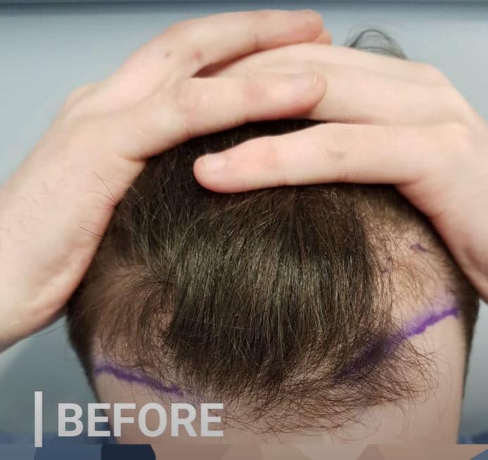 Before and After hair transplant - Ailesbury Hair Clinic UAE - DUBAI