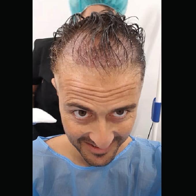 Client after a hair trasnplant Dubai